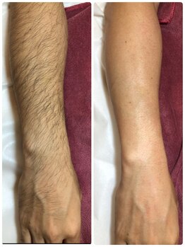 エクラ(eclat)の写真/第一印象は“腕”で変わる!!【腕脱毛】

