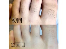 サロン ルーシュ(salon ruche)/脱毛(足の甲指)