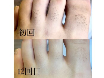 サロン ルーシュ(salon ruche)/脱毛(足の甲指)