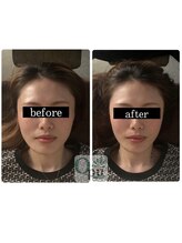 キュープ 松戸店(Qpu)/小顔頭蓋骨矯正