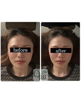 キュープ 松戸店(Qpu)/小顔頭蓋骨矯正