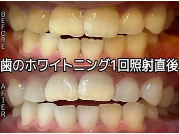 ヴィオール 名古屋栄店(VIOR)/1回で黄ばみ解消！印象UP♪