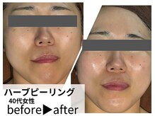 サロンスペース/20代女性【ハーブピーリング】