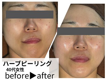 サロンスペース/20代女性【ハーブピーリング】