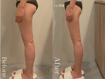 ユーフォリア グロウ(euphoria glow)/{ ラフォス90分×EMS15回 }