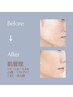 【メンズエステ】×【フェイシャル】シミ/シワ/たるみ/ニキビ¥5,800→