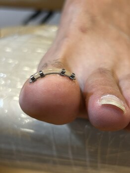 アオドットネイル(Ao. Nail)/ワイヤーを使った巻爪矯正