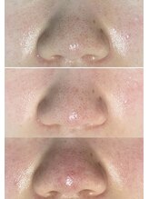 アンドワイ バイ サロンリーナ(&y by Salon Lena)/【徹底的毛穴洗浄×ハーブ】