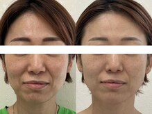 シミケア専門店 SAKURA 平塚店/平塚/ハーブピーリング