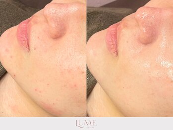 ルーミー 南青山(LUME)/ニキビケア/卵肌/陶器肌