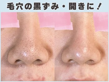ロエヴェ(ROEWE)の写真/新聞にも取材された毛穴と素肌の専門店!施術実績10万人超!一人ひとりに合わせたケアで理想の素肌を目指す!