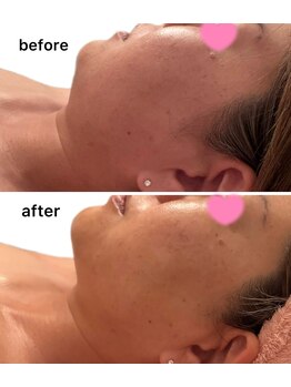 エ アラ エ(E.ala.e)の写真/【小顔特集】大人気レモンボトル導入！大人女性にも大好評◎二重あご・たるみにお悩みの方へすっきり小顔★