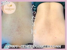 ハーバリー ハーブピーリング 大阪梅田店(HERBERRYハーブピーリング)/梅田ハーブピーリングHERBERRY