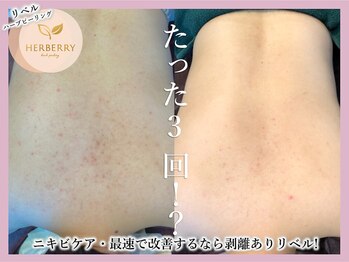 ハーバリー ハーブピーリング 大阪梅田店(HERBERRYハーブピーリング)/梅田ハーブピーリングHERBERRY