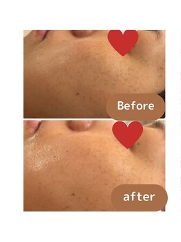 ティンクルホワイト 上尾店/ハーブピーリング施術後