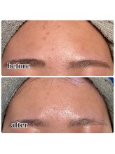 レピア つくば店(LEPIA)/ニキビケア