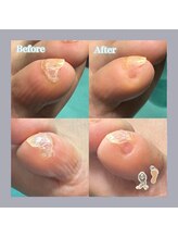 巻き爪補正店 天王寺店/ひっかかる、小指の爪のような物