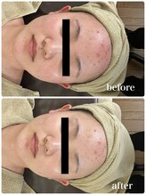 ジャスミン(Jasmin)/ニキビ・毛穴ケア