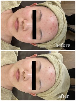 ジャスミン(Jasmin)/ニキビ・毛穴ケア