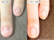 カピリナ(Ka Pilina)/自爪育成・深爪・川崎