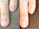 自爪育成・深爪・川崎
