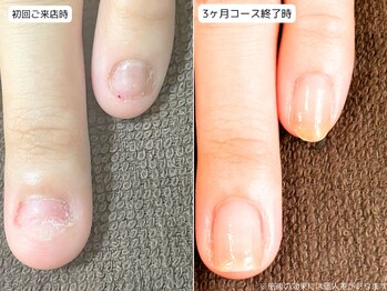 カピリナ(Ka Pilina)/自爪育成・深爪・川崎