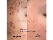 ニキビケア/肌質改善はエルモサハーブピーリング☆