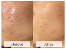 ルミラポー(Lumira Peau)/肌質改善