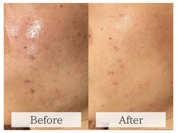 ルミラポー(Lumira Peau)/肌質改善