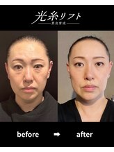 ヘルディン(heldin +555)/光糸リフト before→after