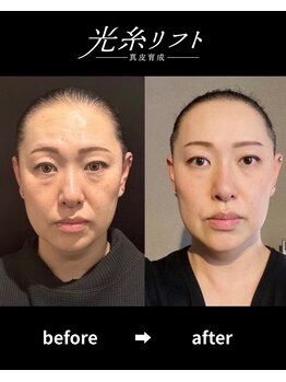 ヘルディン(heldin +555)/光糸リフト