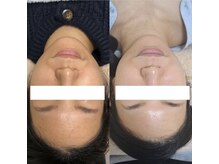 ビーダブリュー(BW...)/☆プラズマゼノデュアル施術例☆