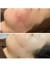 リラベル(Lira Belle)/赤みが引きました