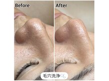 エ リンダ(E- LINDA)の雰囲気(毛穴詰まりはしっかりケアしてトラブル知らずの肌に♪)