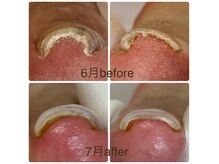 エフ(f)の雰囲気(長年悩んでいる巻き爪ご相談ください♪)