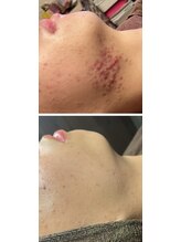 雅菜(miyabina)/思春期ニキビケア！メンズエステ