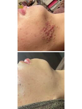 雅菜(miyabina)/思春期ニキビケア！メンズエステ