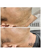 ランプ(LAMP)/～ハイブリッドヒゲ脱毛～