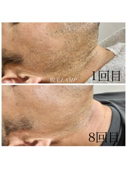 ランプ(LAMP)/~ハイブリッドヒゲ脱毛~