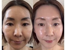 リノン(LIINON)/スキンケアでこの変化！？