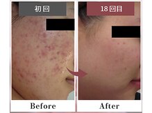 フルリール/【ニキビケアプロテクション】