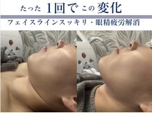 モミ(MOMI)/1回の小顔ケア例