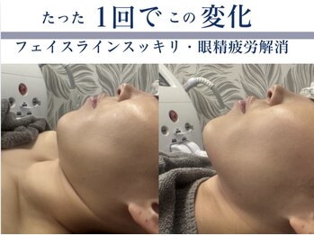モミ(MOMI)/1回の小顔ケア例
