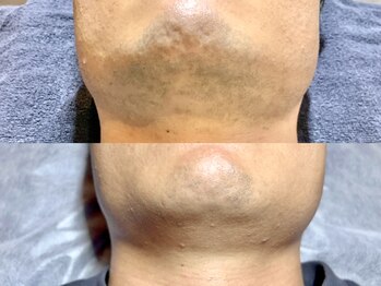 エモーショナル 姫路(Emotional)/8回目経過のお写真