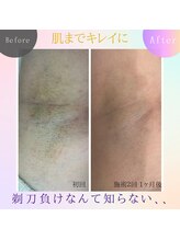 エミュ(emu)/ワキ脱毛