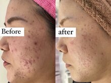 アワピール 成田公津の杜店(AWA PEELL)/ハーブピーリングで肌荒れ改善