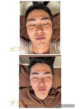 エリシオン(ELYSION)/ハイドロフェイシャル