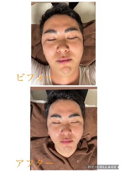 エリシオン(ELYSION)/ハイドロフェイシャル