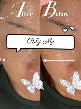 リリーミー(Rily Me)/Gloss肌トリートメント