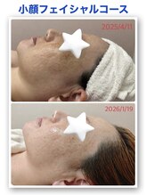 BEAUTYSALONカトレア獨協大学前店【3/5 NEW OPEN（予定）】/★小顔リフトアップ★